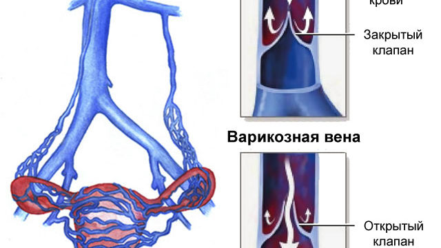 Варикоз Малого Таза Симптомы